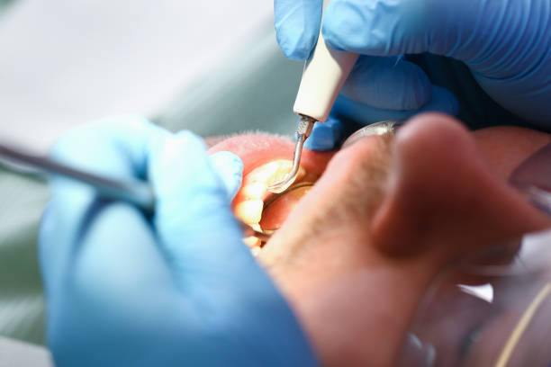 Best Emergency Root Canal Treatment in Siesta Shores, TX