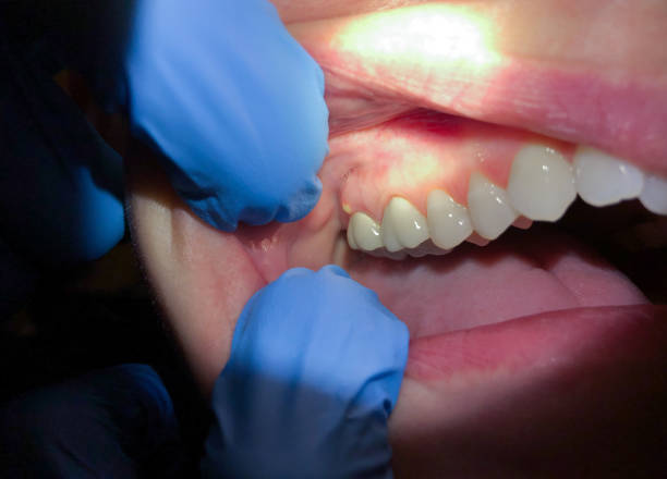 Best Emergency Wisdom Teeth Removal in Siesta Shores, TX